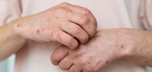 Psoriasis et Savon d'Alep